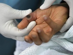 Ada Kasus Baru Cacar Monyet di DKI, Kemenkes Lapor 7 Orang Jadi Kontak Erat