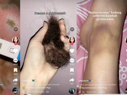 Viral Wanita Alami Gejala Autoimun Bertubi-tubi Rambut Rontok sampai Sulit Jalan
