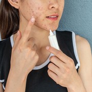 Ups, Flek Hitam Ternyata Juga Bisa Muncul di Kulit Remaja, Lho! Apa Sih, Penyebabnya?