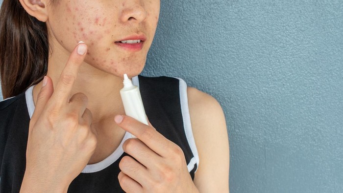 Ups, Flek Hitam Ternyata Juga Bisa Muncul di Kulit Remaja, Lho! Apa Sih, Penyebabnya?