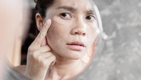 4 Kebiasaan yang Menyebabkan Flek Hitam, Bikin Tidak <i>Pede</i>