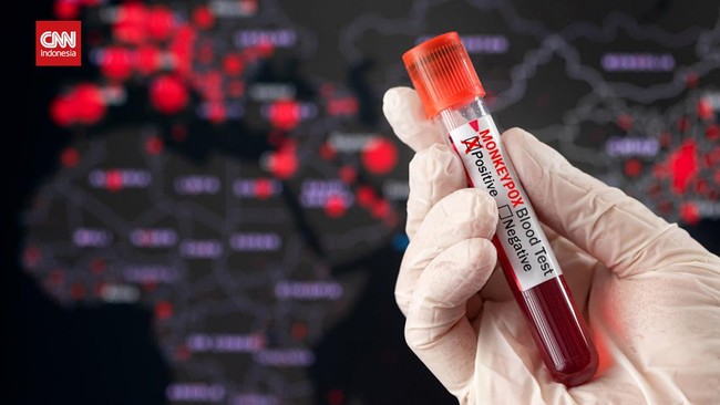 Pemerintah Provinsi DKI Jakarta mengimbau agar warga tak panik menyusul kasus pertama pasien cacar monyet atau monkeypox di Indonesia.