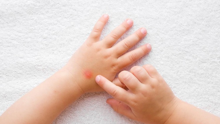 Ilustrasi Asma Kulit Baby girl finger pointing to itchy hand skin after mosquito bites on white towel background. Point of view shot. Closeup. Top down view.