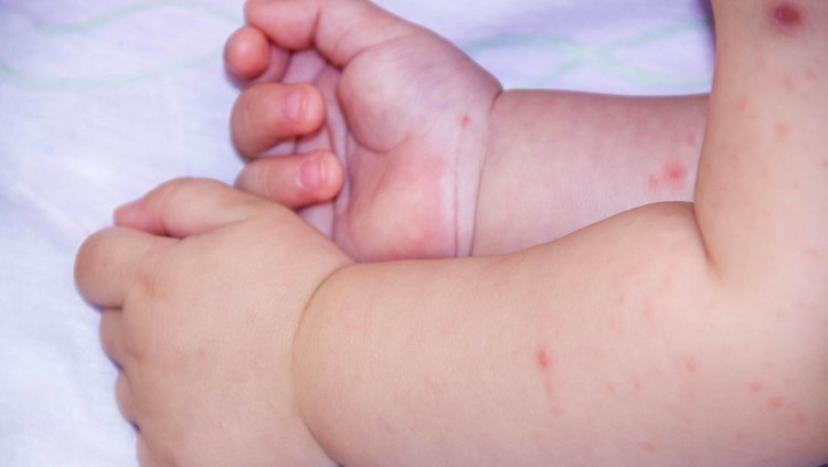 Ilustrasi Asma Kulit A small hand of child covered by eczema. allergy baby skin dermatitis food. child dermatitis symptom problem rash. face sleeping newborns. suffering atopic symptom on skin cheeks. concept child health