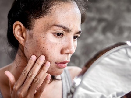Benarkah Purging Terjadi karena Tak Cocok Skincare? Simak di Sini Bun