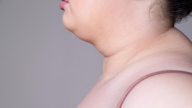5 Cara Menghilangkan Lemak di Dagu, Bye Double Chin