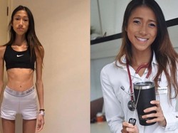 Terobsesi Kurus, Dokter Ini Sempat Punya BB 30 Kg Sampai Hampir Meninggal