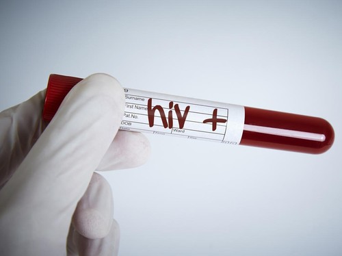 454 Kasus HIV AIDS di Makassar Tahun 2025 Didominasi Homoseksual