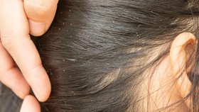 9 Mitos Kutu Rambut: Tak Gatal Berarti Tak Kutuan