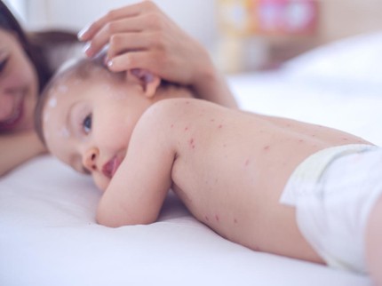 Cacar Air pada Anak Jangan Dianggap Sepele! Simak Gejala & Cara Mengatasinya