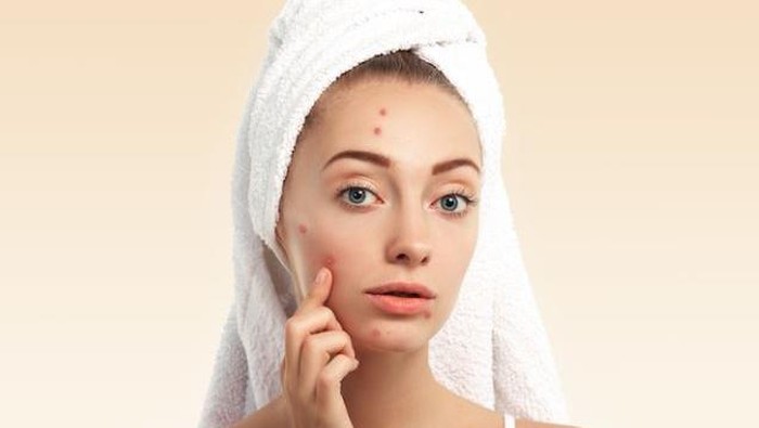 Kenali Jenis-jenis Jerawat, Supaya Tahu Cara Tepat Mengatasinya Secara Maksimal