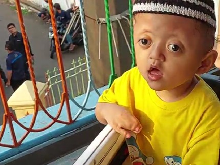 Menderita Sindrom Langka dengan Jari yang Menempel, Anak Buruh Cuci Ini Terus Semangat!