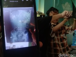 Jabar Hari Ini: Geger Bocah Telan Kunci hingga Kecelakaan Maut di Cipali