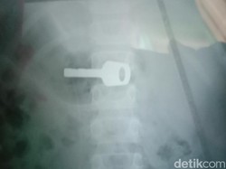Ngeri! Bocah Indramayu Telan Kunci Gembok Sambil Asyik Main HP