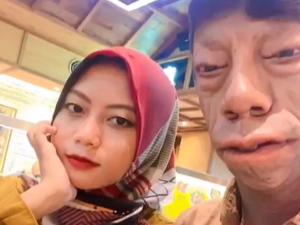 Surya Manurung Pengidap Sindrom Langka Kini Sudah Nikah, Bersyukur Dapat Istri yang Tulus