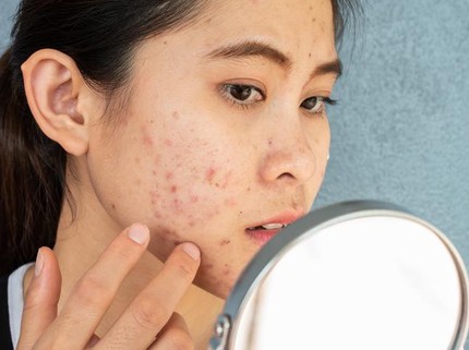 3 Ciri Jerawat karena Tidak Cocok Skincare, Bunda Perlu Hati-Hati