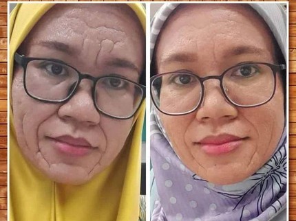 Kisah Wanita yang Kulitnya Menebal Seperti Menua setelah Melahirkan
