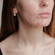 Jangan Panik! Ini Dia 4 Tips Ampuh Untuk Atasi Kulit Breakout