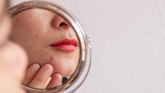 Ilustrasi Skincare Jerawat
