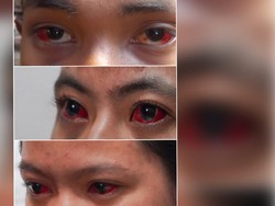 Viral Penampakan Mata Merah Disebut Korban Gas Air Mata Kanjuruhan, Berbahaya?