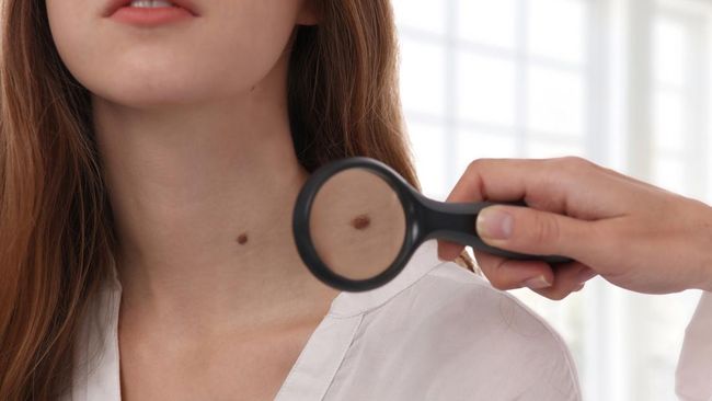 Melanoma atau kanker kulit seperti yang dialami Khloe Kardashian biasanya dimulai dari tahi lalat. Namun, tahi lalat ini terlihat tak biasa. Berikut cirinya.