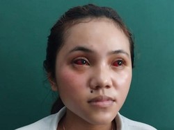 Mahasiswi Widyagama Terpapar Gas Air Mata Kedaluwarsa, Wajahnya Bintik-bintik