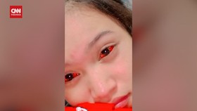 VIDEO: Mata Merah yang Masih Diderita Korban Gas Air Mata Kanjuruhan