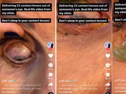 Bikin Ngilu, Penampakan Dokter Lepaskan 23 Softlens yang Tertimbun di Mata