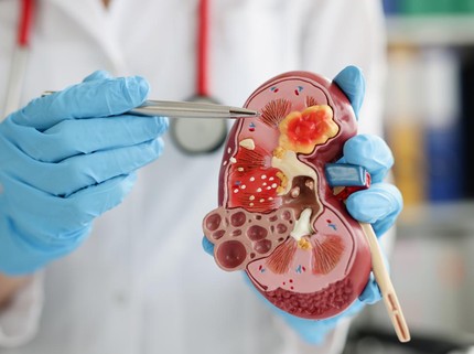 7 Kebiasaan Sepele yang Bisa Merusak Ginjal, Hindari Ya Bun