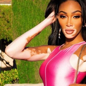 img-title Winnie Harlow, Supermodel Vitiligo yang Telah Berjuang Melawan Standar Kecantikan Sejak Kecil