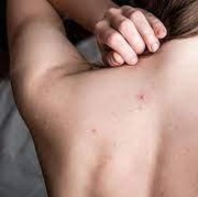 5 Langkah Mudah Atasi Jerawat Punggung