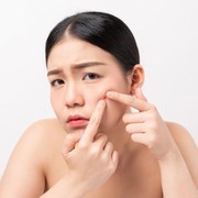 5 Manfaat Acne Patch yang Perlu Kamu Ketahui
