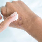 Bekas Luka Menghitam Bikin Nggak Percaya Diri? Simak Cara Mengatasinya Berikut Ini!