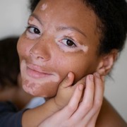 Mengenal Penyakit Vitiligo dan Beragam Perawatannya yang Perlu Beauties Ketahui