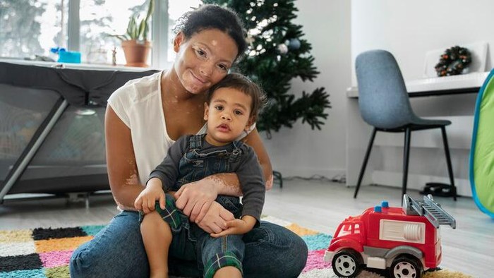 Memahami tentang penyakit vitiligo/Foto: Freepik/Freepik