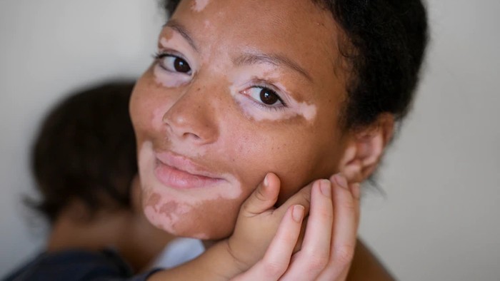 img-title Mengenal Penyakit Vitiligo dan Beragam Perawatannya yang Perlu Beauties Ketahui