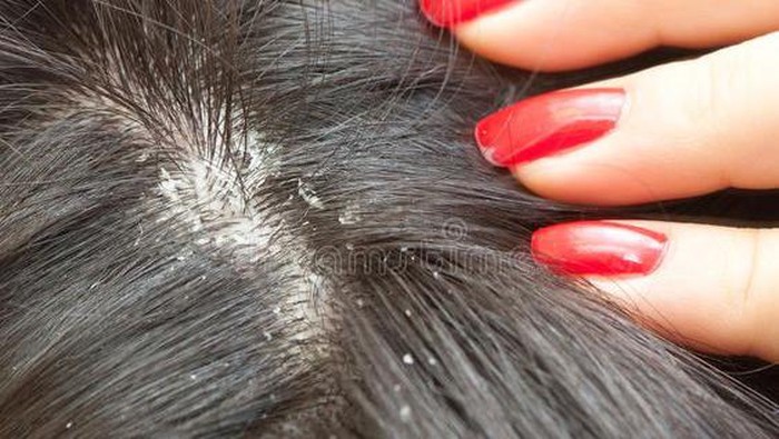 BeauPicks: 4 Rekomendasi Sampo untuk Penderita Dermatitis Seboroik BeauPicks: 4 Rekomendasi Sampo untuk Penderita Dermatitis Seboroik
