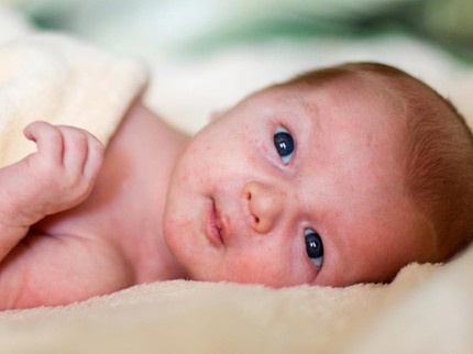 Beruntusan pada Bayi Baru Lahir: Penyebab, Jenis, dan Cara Mengatasinya