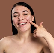 Ketahui Penyebab dan Arti Letak Jerawat di Wajahmu Lewat Metode Face Mapping, Simak Yuk!