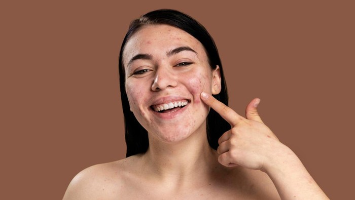 Ketahui Penyebab dan Arti Letak Jerawat di Wajahmu Lewat Metode Face Mapping, Simak Yuk! Ketahui Penyebab dan Arti Letak Jerawat di Wajahmu Lewat Metode Face Mapping, Simak Yuk!
