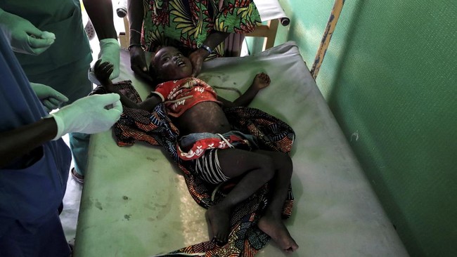 Menurut UNICEF, setidaknya ada 31.342 kasus kolera yang dicurigai atau dikonfirmasi di Kongo, yang berujung pada 230 kematian dalam periode Januari-Juli 2023.
