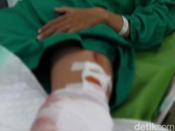 Aksi Heroik Wanita Banyuwangi Tendang Penjambret, Kakinya Robek-Harus Dijahit