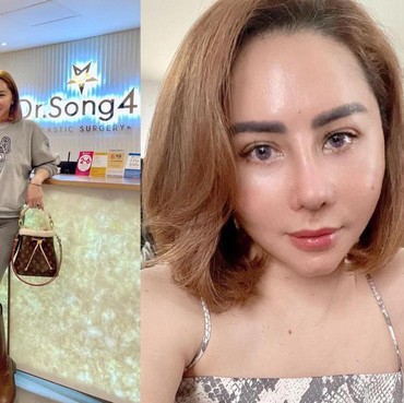 7 Potret Beda Femmy Permatasari Usai Oplas Hidung di Korea