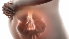 Kisah Cinta Gadis Kembar Dempet, Saat Salah Satunya Punya Pacar