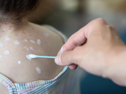 7 Obat Cacar Air di Apotek, Bisa Jadi Rekomendasi Atasi Gatal & Bekas Luka Anak