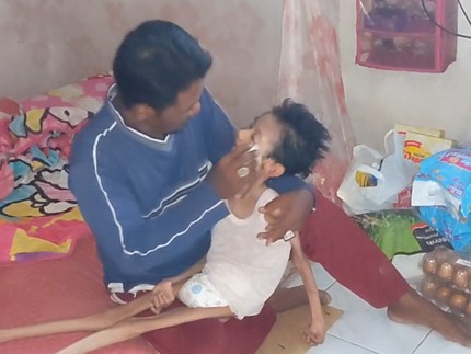 Derita Anak Buruh Bangunan Terbaring Lemas dan Kurus karena Gizi Buruk