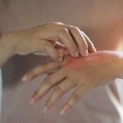 Tak Boleh Pakai Sembarang Produk, Ini Kandungan yang Baik Bagi Penderita Eksim dan Rekomendasi Produknya