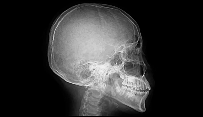 Ilustrasi rontgen tengkorak