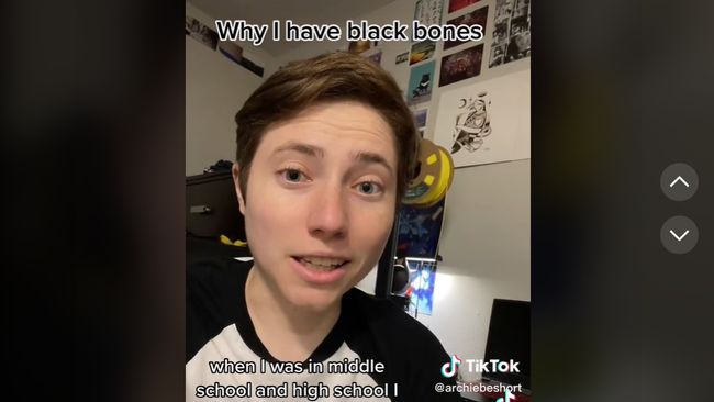 Viral di TikTok, Wanita Kaget Tulangnya Berubah Warna Hitam