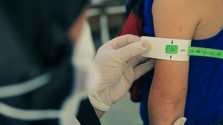 Ilustrasi Stunting dan Gizi Buruk Measuring malnutrition using strap MUAC mid-upper-arm-circumference. A doctor examines child malnutrition